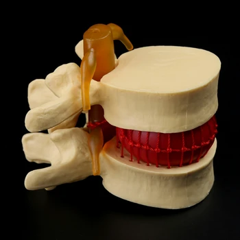 Emberi anatómia Csontváz Gerinc Ágyéki porckorongsérv Tanítási modell Gerincelváltozások Orvosi oktatóeszköz kellékek
